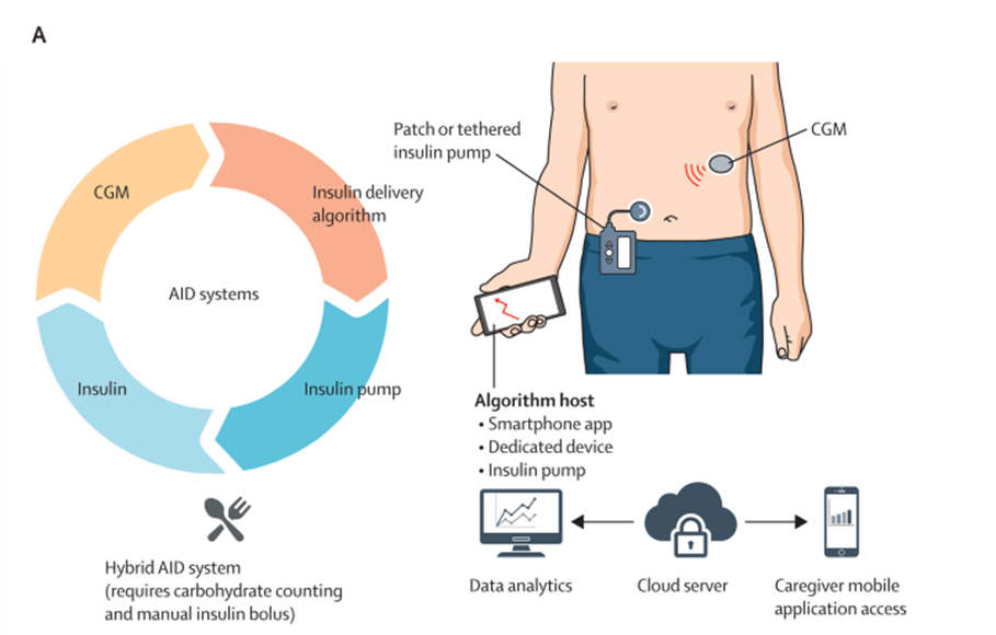 How Innovation is Transforming Type 1 Diabetes Care in 2025 – A World ...