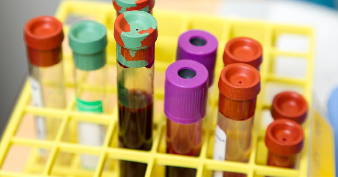 Minimally invasive, maximum potential: liquid biopsy is redefining diagnosis